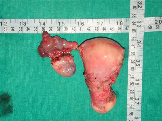 Broadligament fibroid with uterus